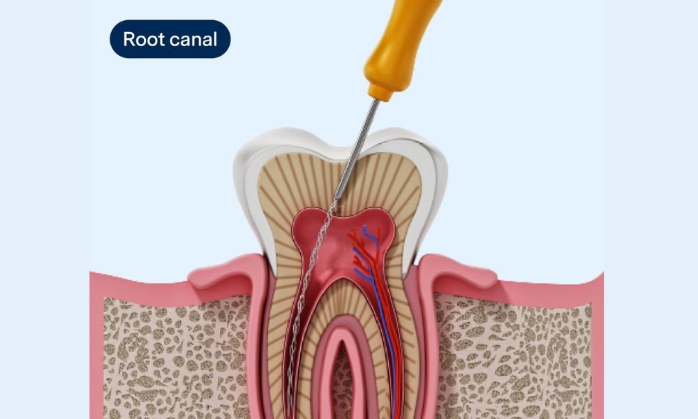Best Root Canal Treatment in Saidapet