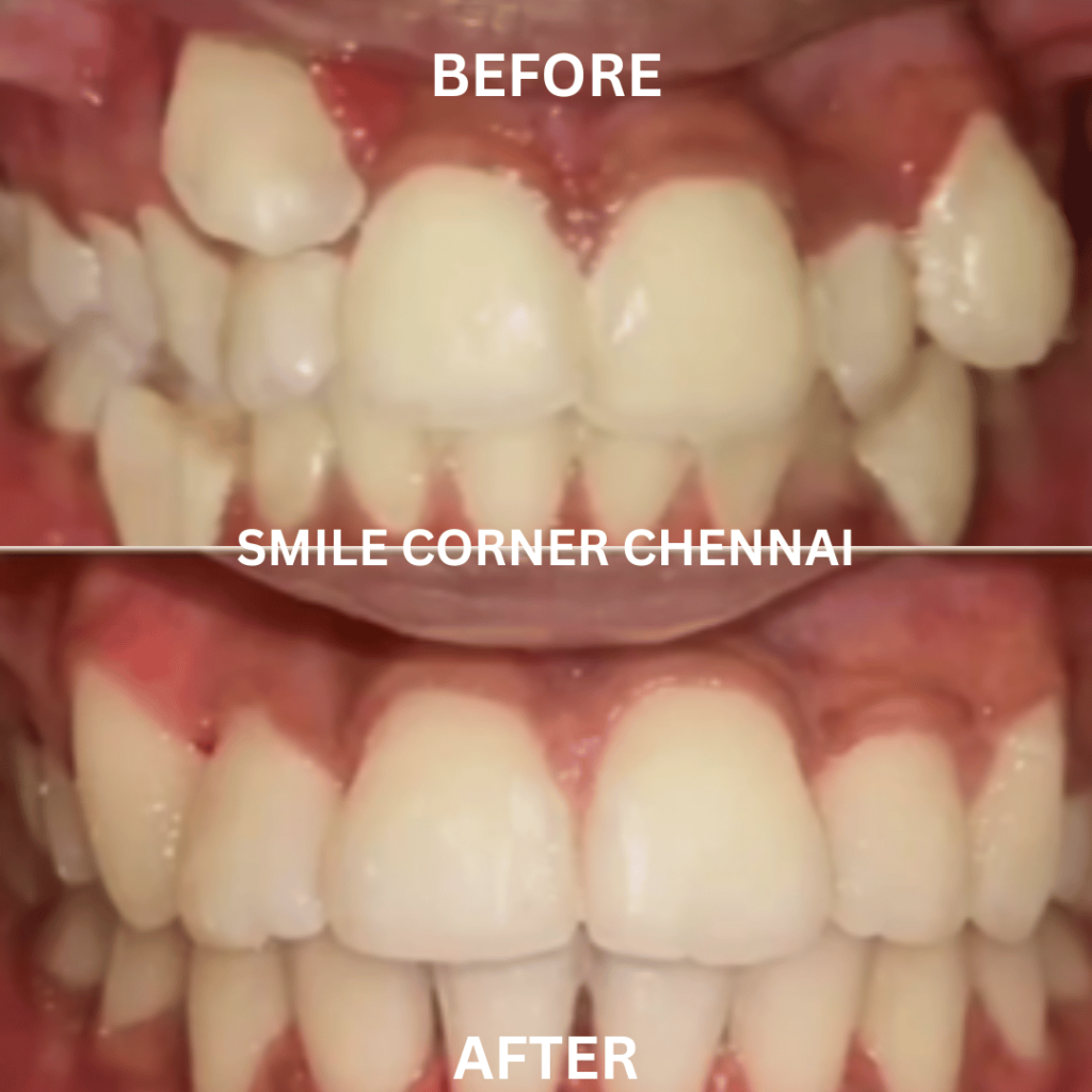 INVISALIGN IN Changes