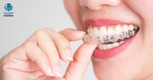 invisalign in chennai
