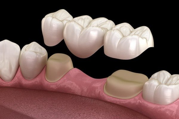 crown and bridge treatment in chennai