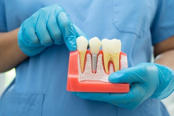 Dental implant in chennai
