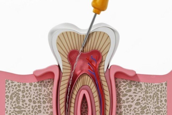 Root canal treatment in chennai
