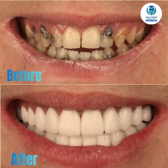 Invisalign before and after results