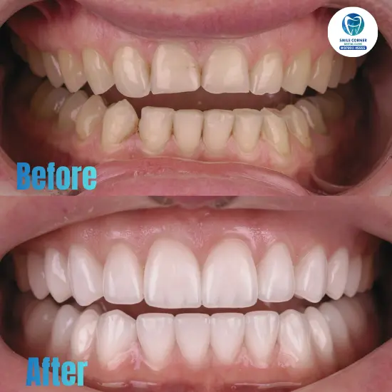 Invisalign specialist Chennai results