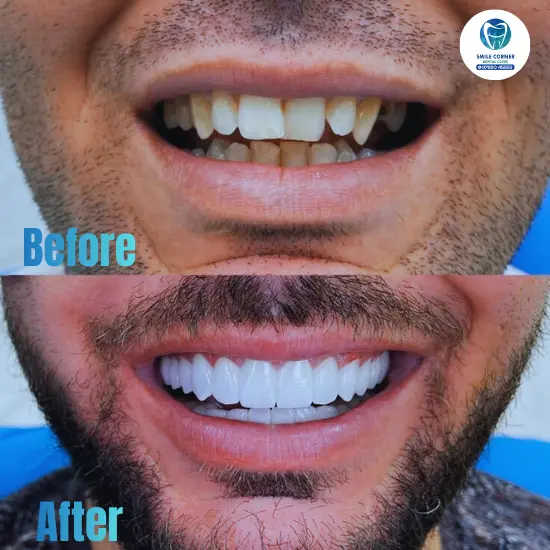 Invisalign results in Chennai