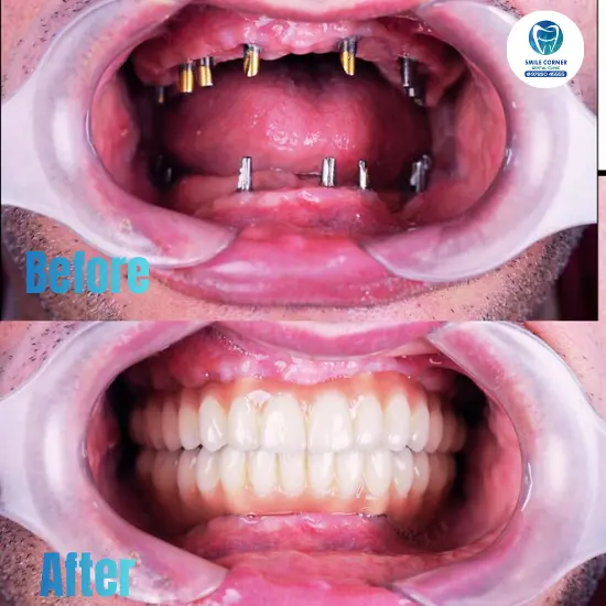 Clear aligners before and after Chennai