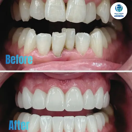 Invisible braces treatment results