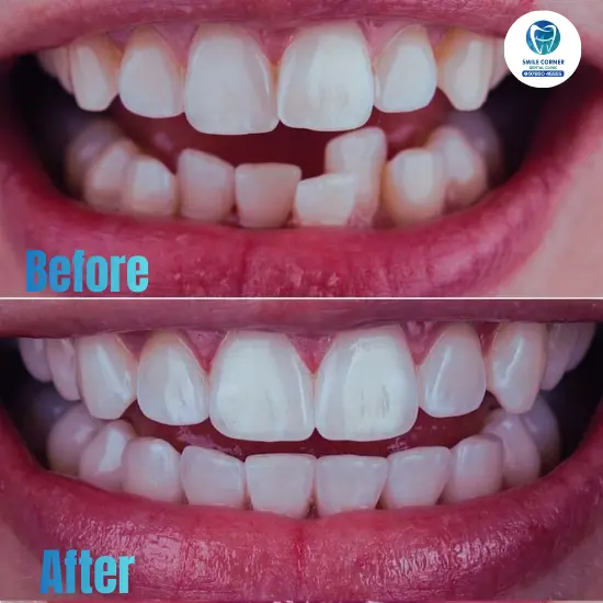 Invisalign smile transformation Chennai