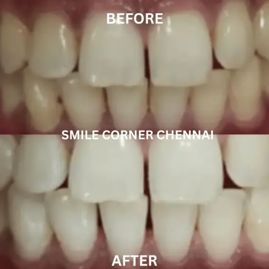 Invisalign in chennai