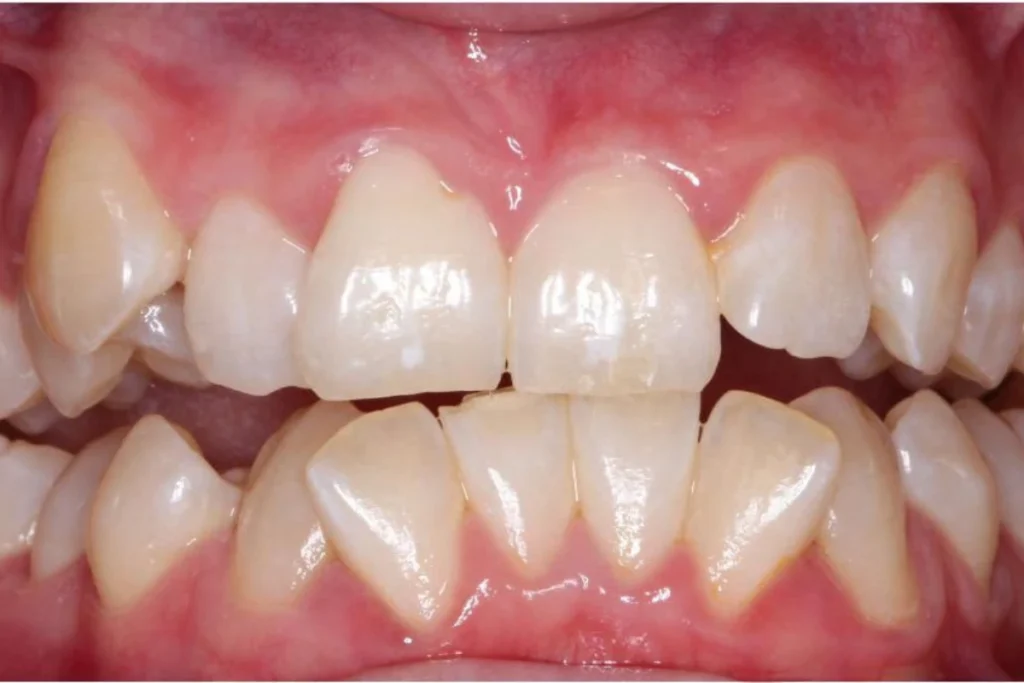 Severe cases invisalign in chennai