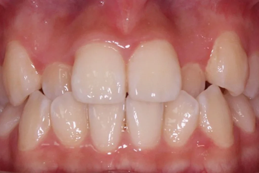 Moderate cases invisalign in chennai