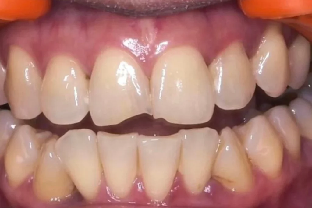 Mild cases invisalign in chennai