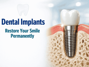 Dental Implants in Saidapet