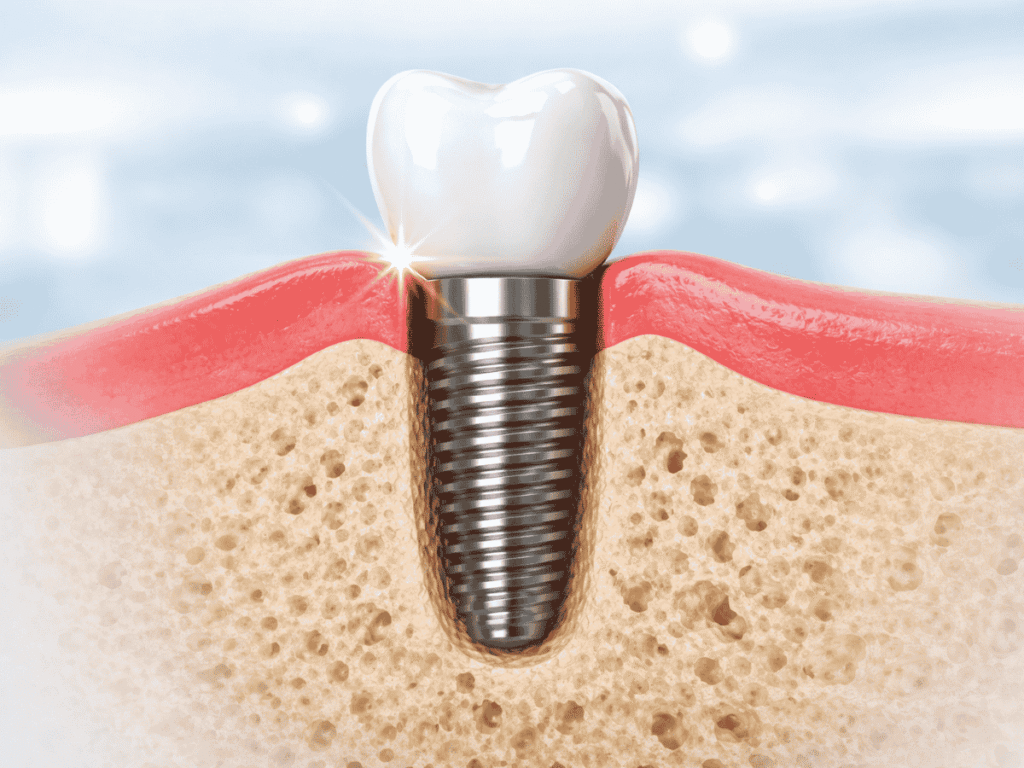 dental implant of jawbone