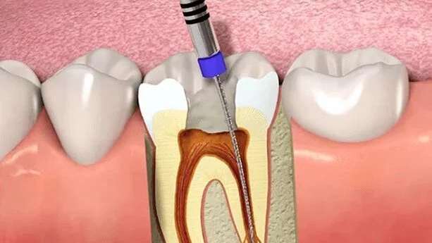 ROOT-CANAL-2