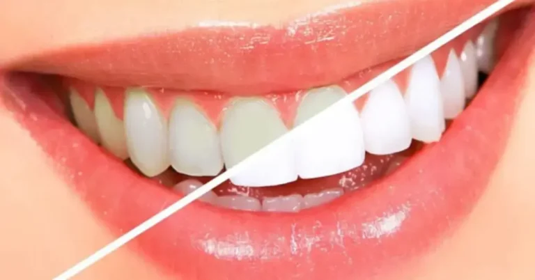 Teeth-whitening-2