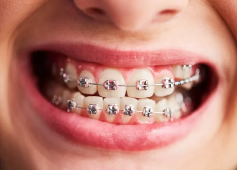 Tooth Alignment-1