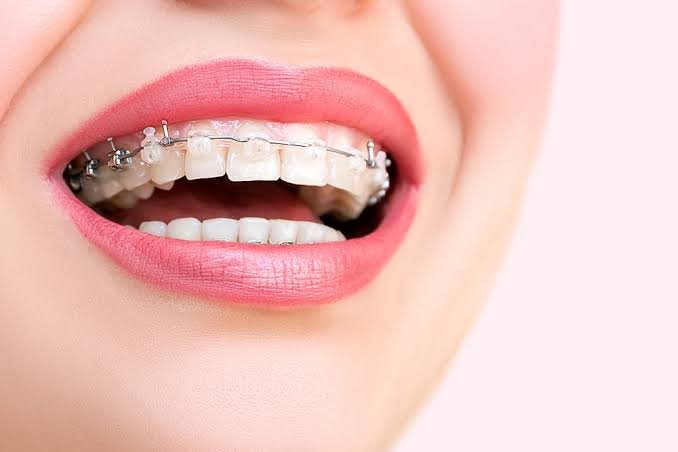 ToothAlignmentinChennai-2