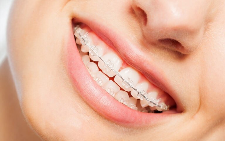 ToothAlignmentinChennai-3