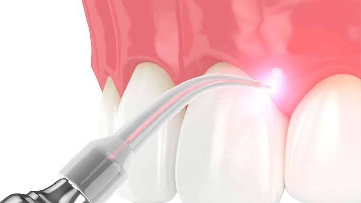 laser dentistry process