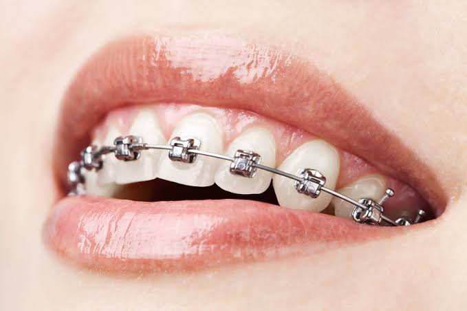 orthodontic-1