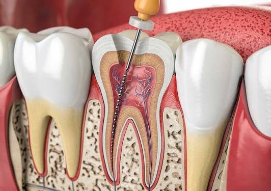 root-canal-3