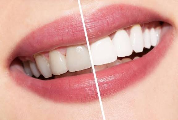 teeth-whitening-3