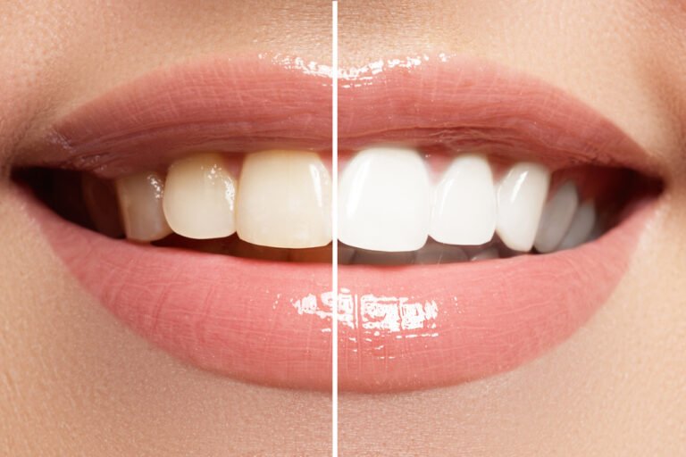 teth-whitening-1
