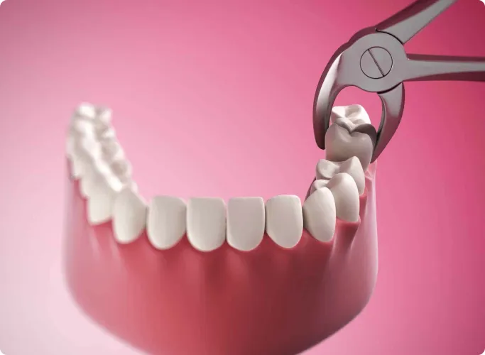 tooth-extraction-1