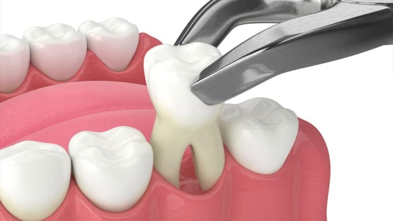 tooth-extraction-2